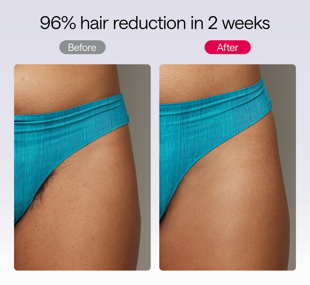 Ulike Laser Hair Removal, Air 10 IPL New