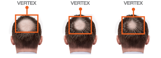 FOLIGAIN Minoxidil 5% Hair Regrowth Treatment For Men.