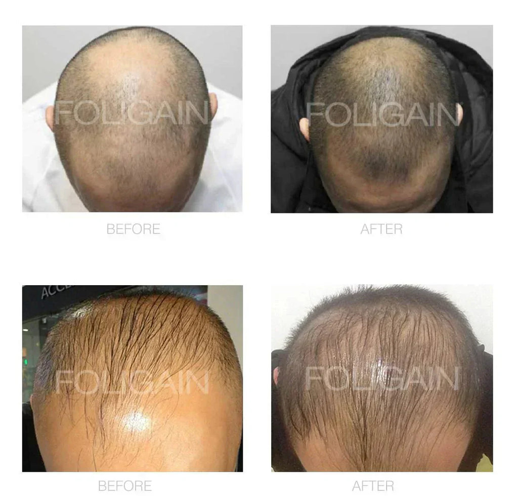 FOLIGAIN Minoxidil 5% Hair Regrowth Treatment For Men.